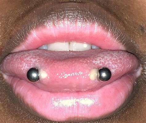 How to Identify and Treat a Tongue Piercing Infection